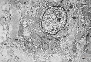 M,11y. | fibrillary astrocytoma